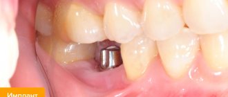 Фото импланта зуба