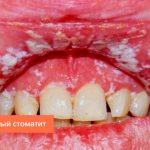 Photo of catarrhal stomatitis