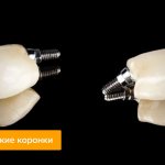 Photos of ceramic crowns on implants