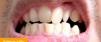 Photo of crooked teeth