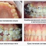 Photos at different stages of treatment with non-ligature braces