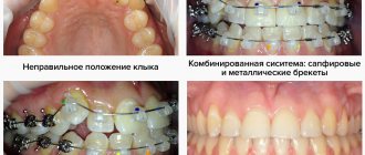 Photos at different stages of treatment with non-ligature braces