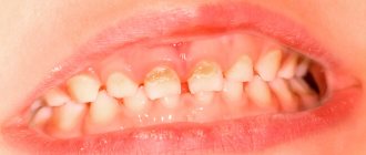 Photo of initial caries of baby teeth