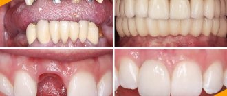 Photo of the patient before and after implantation of anterior teeth