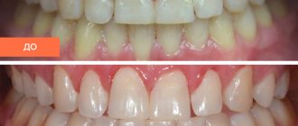 Photo of the patient before and after caries treatment without drilling