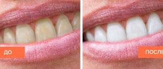 Photo of the patient before and after whitening