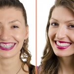 Photo of the patient before and after removing braces from teeth