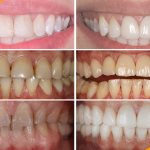 Photo of a patient before and after installation of ceramic veneers at the German Implant Center
