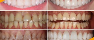 Photo of a patient before and after installation of ceramic veneers at the German Implant Center