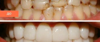 Photo of the patient before and after installation of Empress veneers