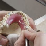Photo of repairing a plate prosthesis