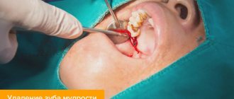 Photo of wisdom tooth removal