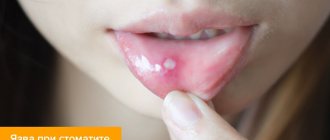 Photo of an ulcer with stomatitis