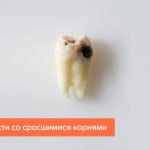 Photo of a wisdom tooth with fused roots