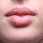 Herpes on the lips: causes, symptoms, which doctor to contact
