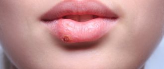 Herpes on the lips: causes, symptoms, which doctor to contact