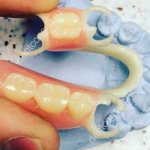 flexible dentures