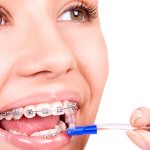 Hygiene when wearing braces