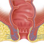 Hypertrophied anal papillae - treatment of inflammation, symptoms, diagnosis, therapy