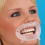 Характеристики роторасширителя Оптрагейт и применение в стоматологии