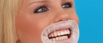 Характеристики роторасширителя Оптрагейт и применение в стоматологии
