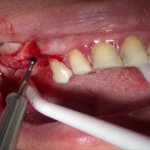 Surgical treatment of atrophy of the alveolar process of the upper jaw