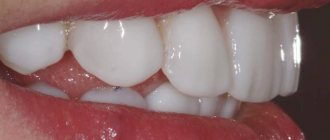 Artistic restoration of teeth