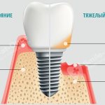 implantation for periodontitis