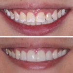 dental enamel implantation cost
