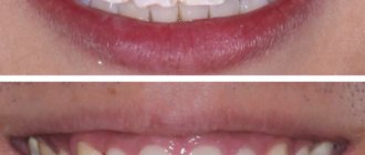 dental enamel implantation cost