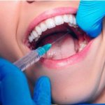 Infiltration anesthesia for dental treatment