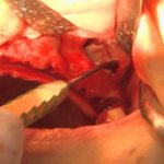 use of aprf to close perforation of the maxillary sinus floor