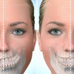 Correcting jaw asymmetry in adults