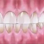 Changing the contour of dental crowns is one of the consequences of “grinding” bruxism
