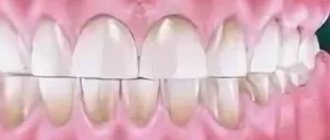 Изменение контура зубных коронок – одно из последствий бруксизма «с измельчением»