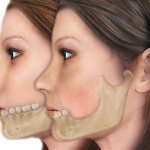 facial changes due to bone atrophy