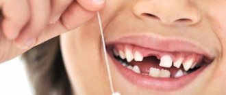 Как безболезненно вырвать зуб?