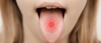 How to get rid of tongue pain?