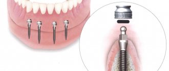 How the prosthesis is attached to mini-implants