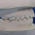 How to work with plaster in dentistry
