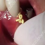 What drainage looks like after tooth extraction - photo