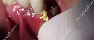 What drainage looks like after tooth extraction - photo