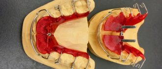 what does a dental plate look like?