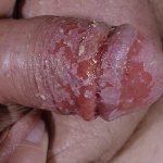 candidiasis of the head and foreskin