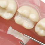 Ceramic tooth inlay