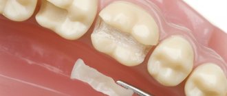 Ceramic tooth inlay