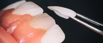 Ceramic veneers - what are they, service life, advantages