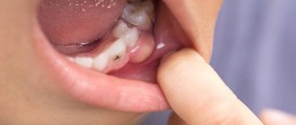 Teething cyst in children