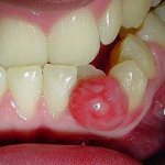 Tooth cyst
