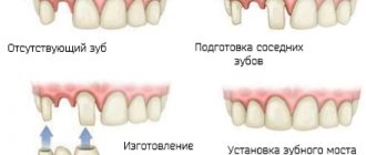 Classification of dentition defects according to Kennedy. Orthopedics 